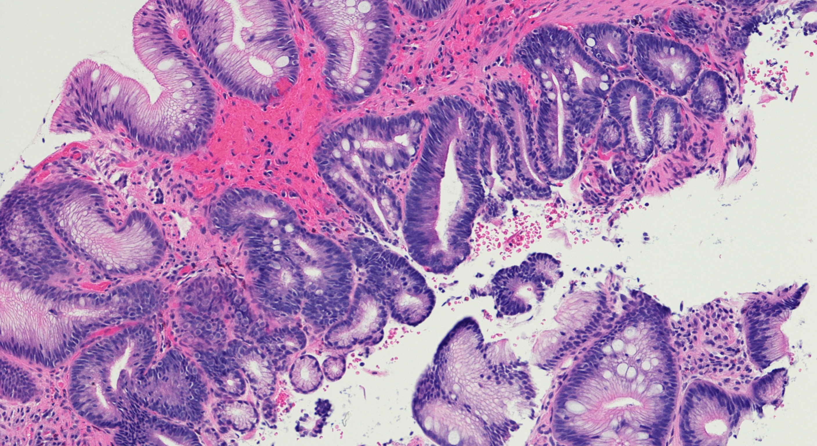 Esophageal Disorders and Motility